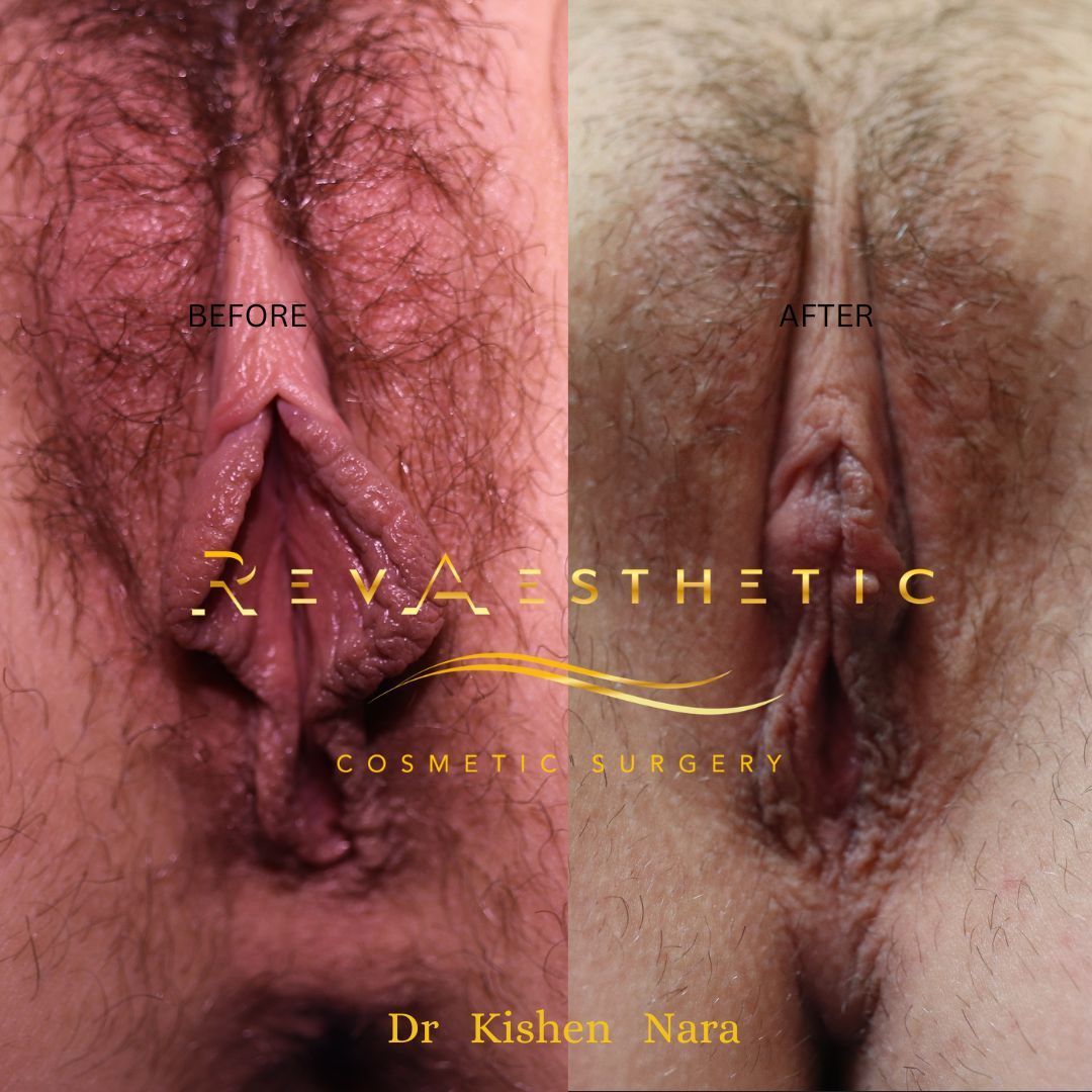 Labiaplasty before and after — SAP labiaplasty, before and after, Case 2, Dr Kishen Nara